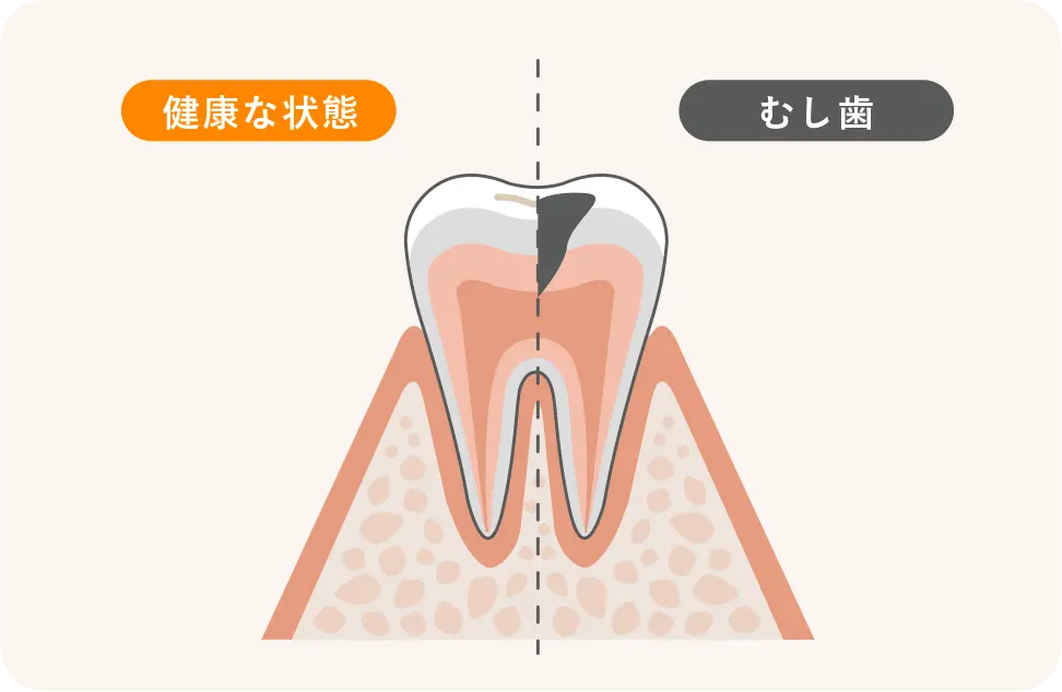 むし歯は、細菌により歯が溶け出す疾患