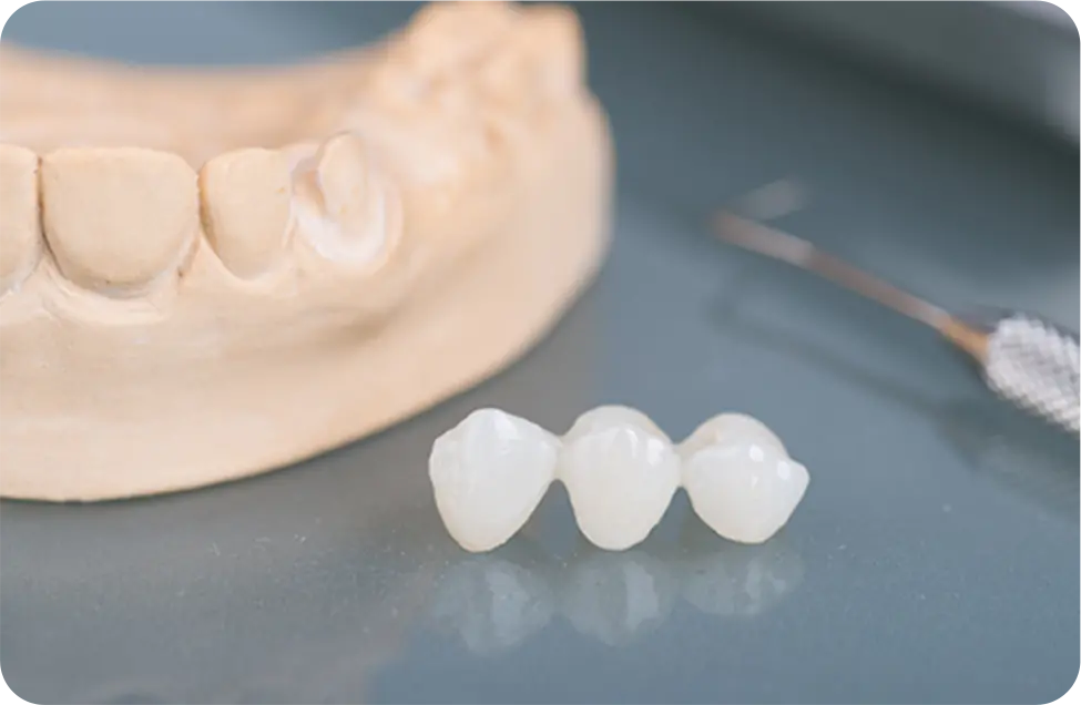 正常な咬み合わせをつくるために歯の欠損部分を修復する