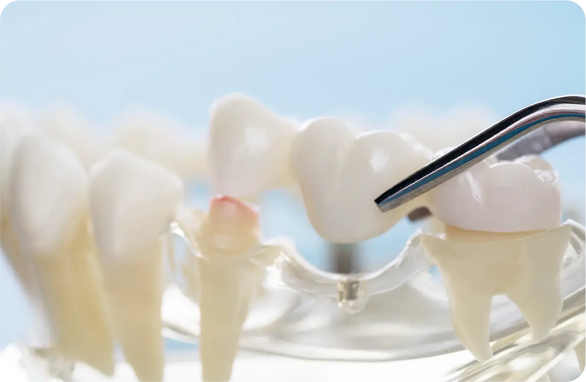 両隣の歯を支えに 欠損歯を補う 